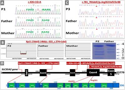 Four New Cases of SLC35A2-CDG With Novel Mutations and Clinical Features